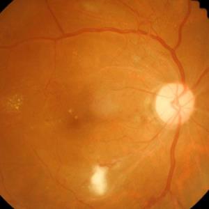 Rising prevalence of diabetic retinopathy increases the urgency of early screening