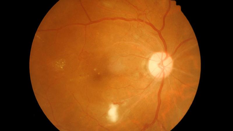 File photo of diabetic retinopathy.