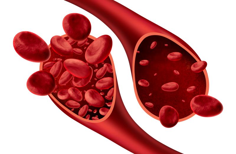 Treating iron deficiency in patients with heart failure: The role of ferric carboxymaltose