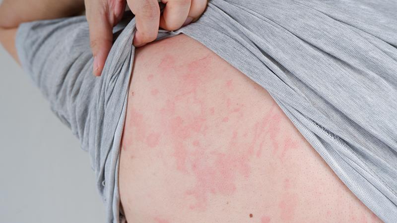 Stock image showing urticaria on a patient’s back.