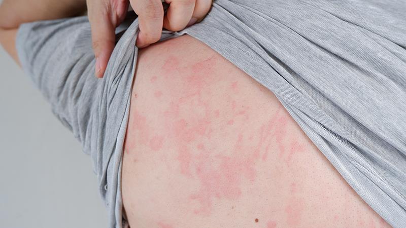 Stock image showing urticaria on a patient’s back.