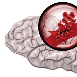 Giving tPA before thrombectomy still holds in stroke