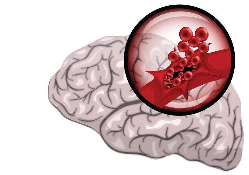 Giving tPA before thrombectomy still holds in stroke