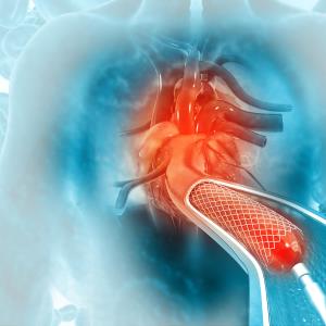 Similar long-term outcomes with iFR- vs FFR-guided revascularization