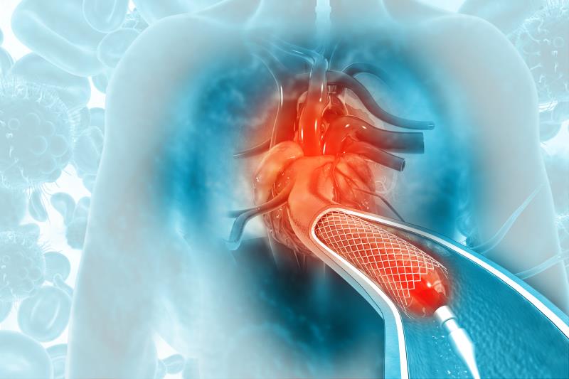 Similar long-term outcomes with iFR- vs FFR-guided revascularization