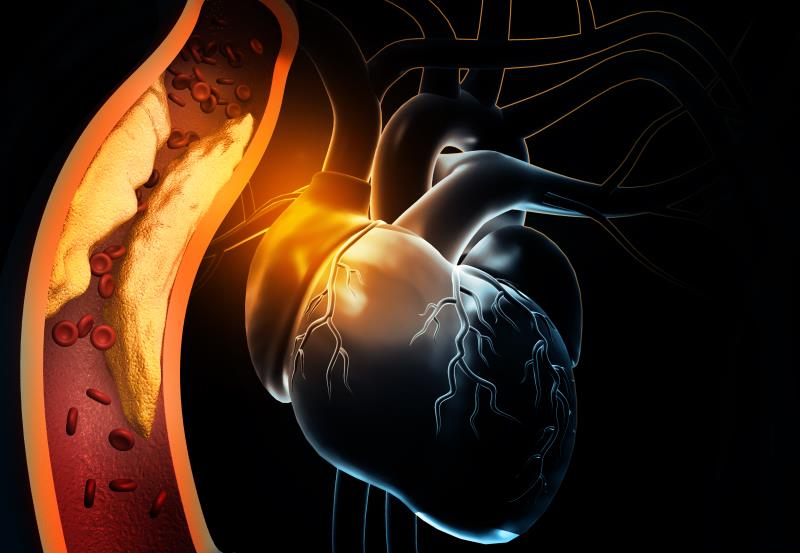 Olmesartan-amlodipine single-pill + rosuvastatin reduces SBP, LDL-C in concomitant hypertension, dyslipidaemia