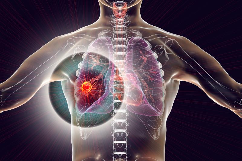 Subcutaneous amivantamab compares favourably with intravenous dosing in EGFR-mutant NSCLC