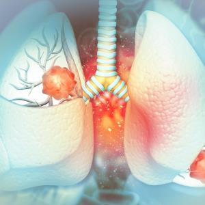 Sintilimab-IBI305-chemo improves PFS in EGFRm non-squamous NSCLC