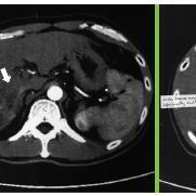 Which factors predict mortality in advanced HCC?