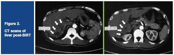 Which factors predict mortality in Atezo/Bev-treated advanced HCC?