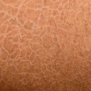 Generalized, local dry skin common among middle-aged adults, seniors