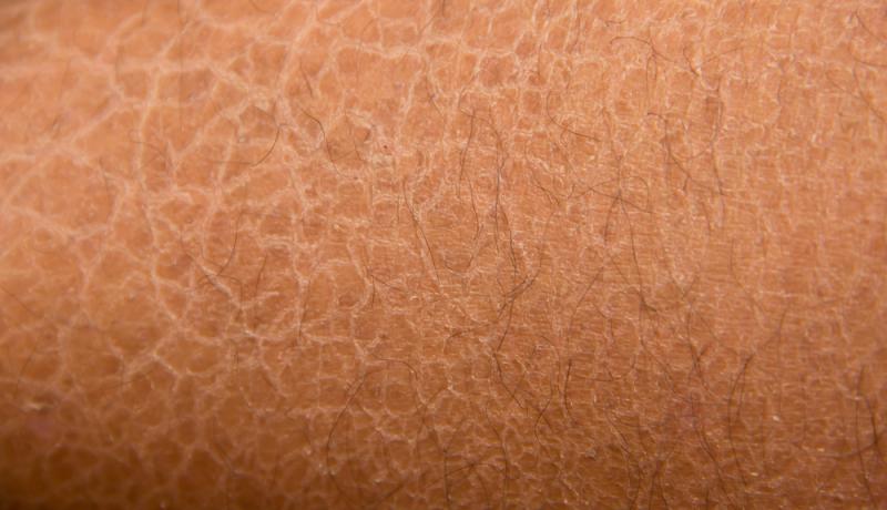 Generalized, local dry skin common among middle-aged adults, seniors