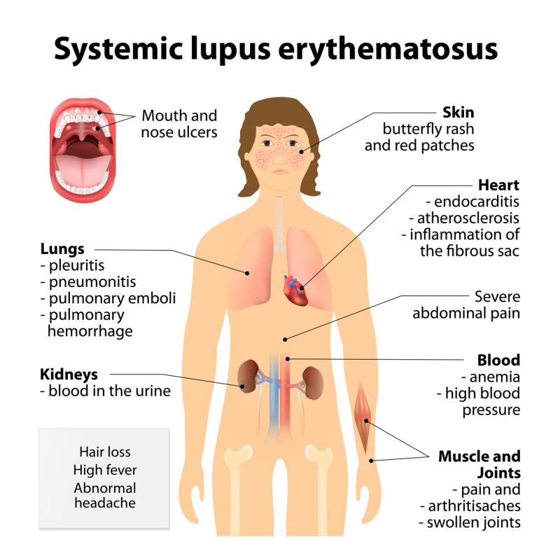 Manifestations of SLE