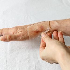 Some patients hesitant to perform self-wound care