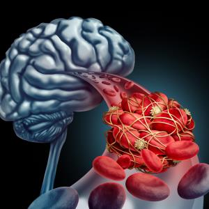 ODYSSEY: Alirocumab cuts risk of ischaemic stroke without increasing haemorrhagic stroke