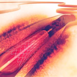 Polymer-free less effective than polymer-based stent for PCI?