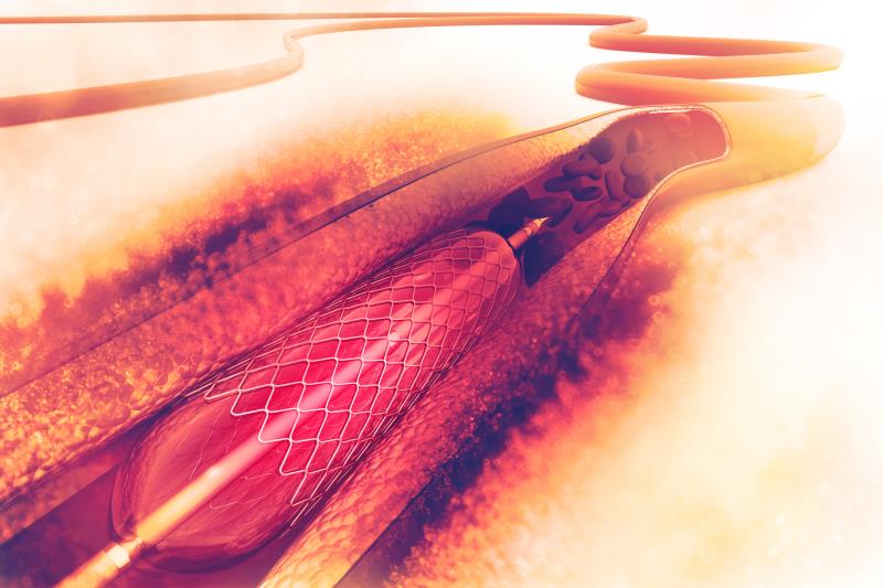 Polymer-free less effective than polymer-based stent for PCI?