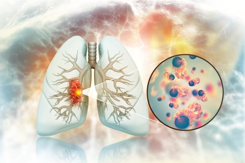 Sotorasib offers a paradigm shift in the treatment of KRAS G12C-mutated NSCLC