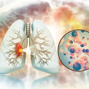 Pretreatment serum CEA level predicts survival in NSCLC