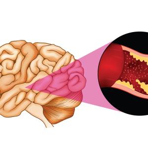 Sovateltide: A new option to improve neuro outcomes after cerebral ischaemic stroke?