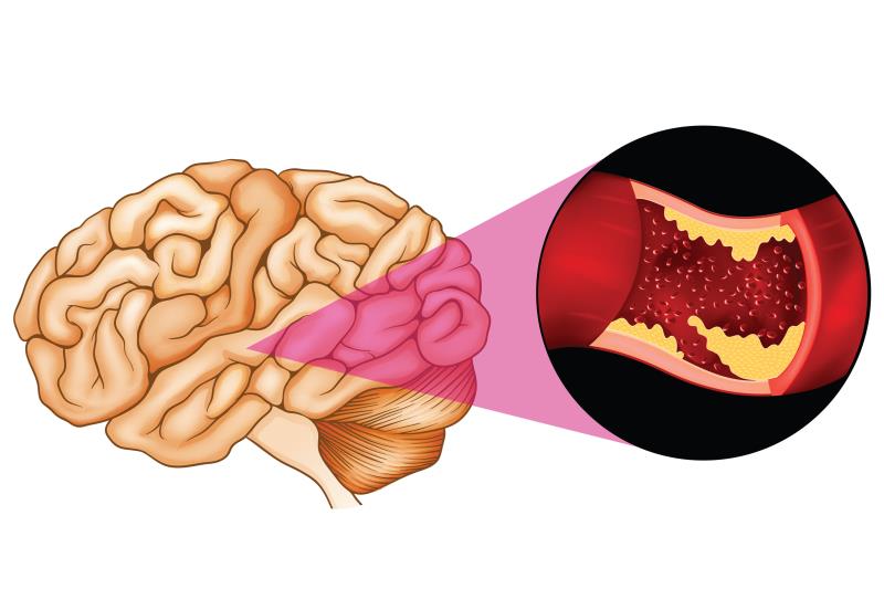 Sovateltide: A new option to improve neuro outcomes after cerebral ischaemic stroke?