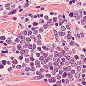 Standardized guidelines missing for treatment of GILCNEC