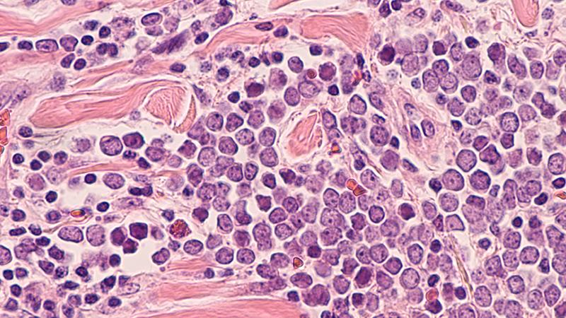 Standardized guidelines missing for treatment of GI large cell neuroendocrine carcinoma