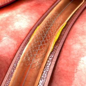 Long-term potent antithrombotic therapy reduces atherothrombotic events after PCI