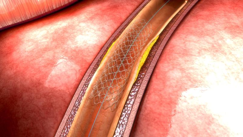 PCI tied to death, MI, stroke in patients with LMCA, LV dysfunction