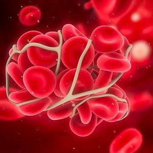 Thrombus aspiration ineffective for STEMI patients