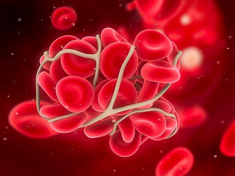 Thrombus aspiration ineffective for STEMI patients