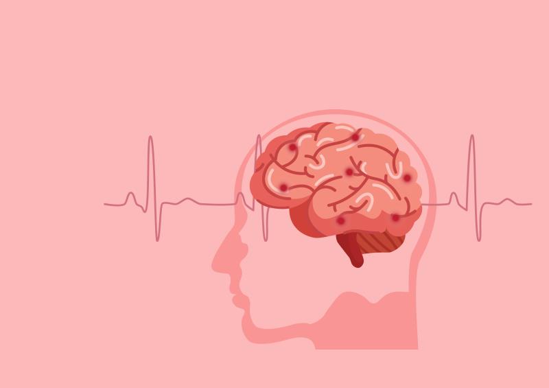 Ischaemic stroke, systemic embolism more likely in patients with hyperthyroidism-related AF