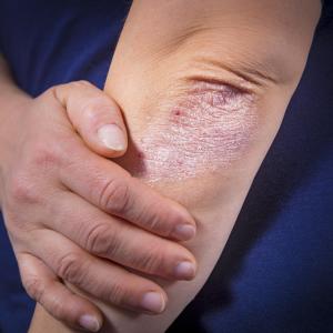 Smoking cessation, preventing obesity help reduce psoriasis risk