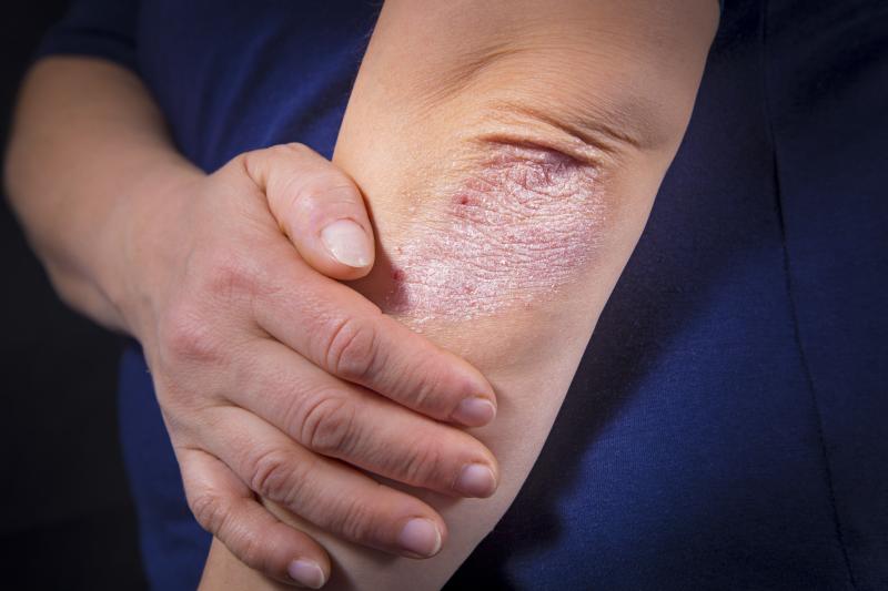 Adalimumab–methotrexate combo better than adalimumab monotherapy in psoriasis