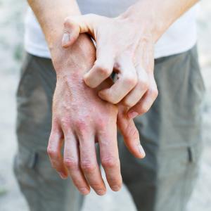 Abrocitinib shows promise in moderate-to-severe atopic dermatitis