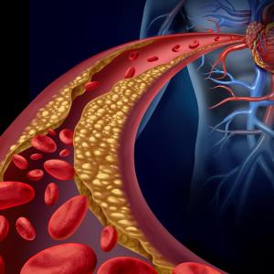 AMI triggered by coronary atherosclerosis vs spasm more likely to result in complications