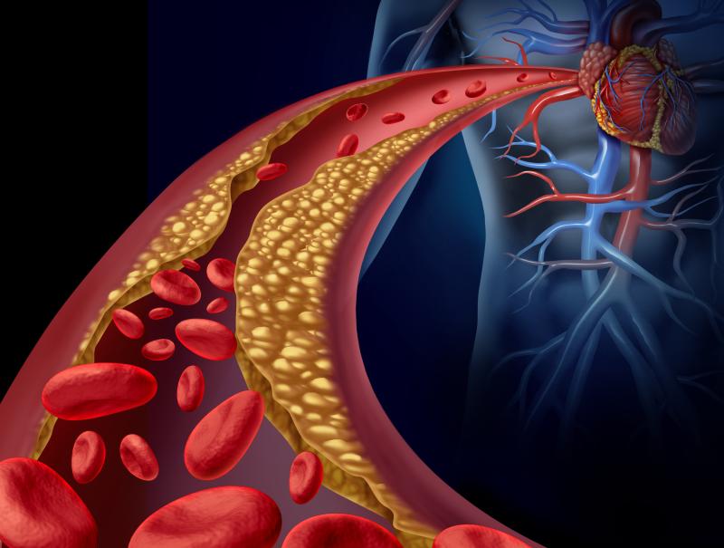 High LDL-C levels up incidence of cardiovascular events after PCI