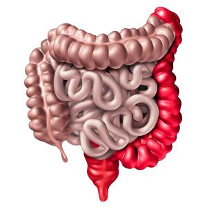 Subcutaneous vedolizumab maintenance attains clinical remission in ulcerative colitis