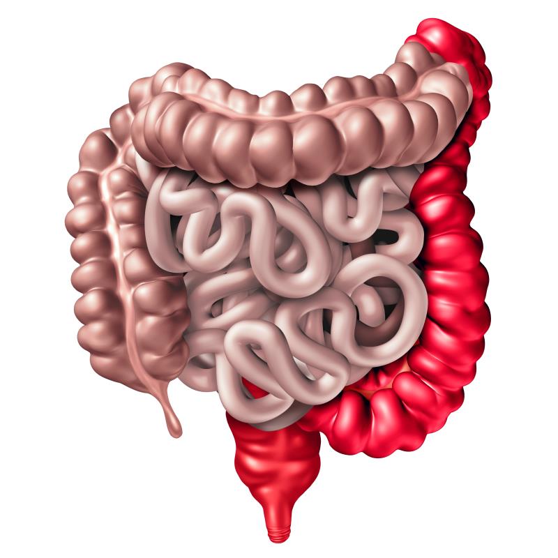 Biologic dose optimization not needed in UC patients with early nonresponse, high drug clearance