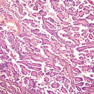 Cabozantinib improves PFS, response in metastatic papillary RCC