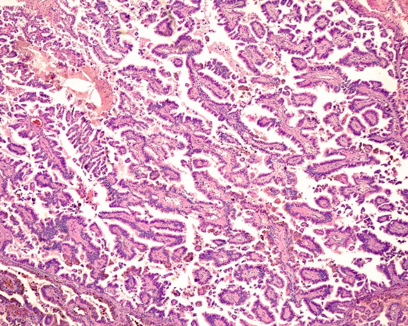 Cabozantinib improves PFS, response in metastatic papillary RCC