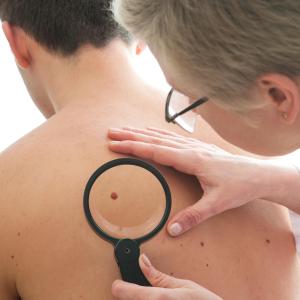 Long-term dermatological surveillance valuable after liver transplant