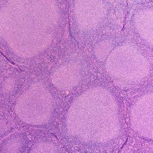 Tafasitamab plus lenalidomide, rituximab boosts PFS in follicular lymphoma
