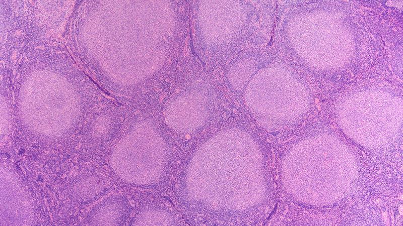 Tafasitamab plus lenalidomide, rituximab boosts PFS in follicular lymphoma
