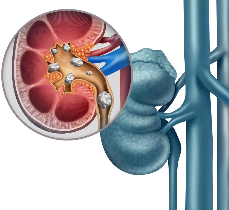 Tamsulosin MET with success in facilitating ureteral stone passage