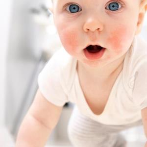 Tapinarof safe, efficacious for moderate-to-severe AD in children, adults