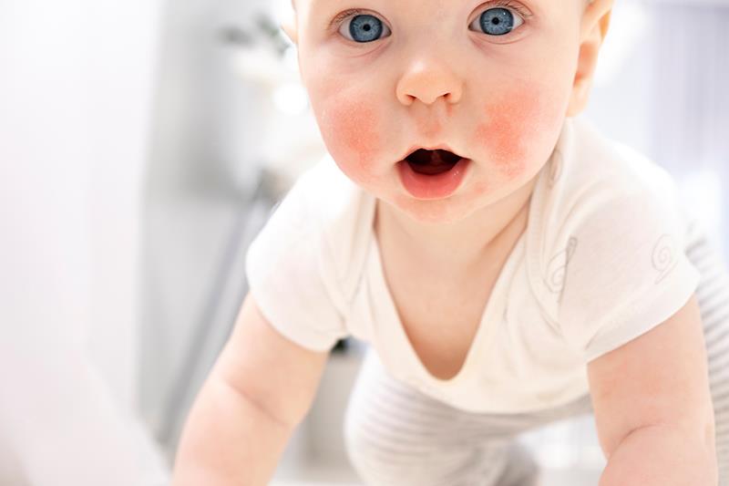 Tapinarof safe, efficacious for moderate-to-severe AD in children, adults