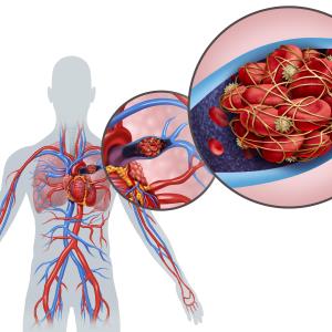 Bashir catheter shows treatment potential for pulmonary embolism