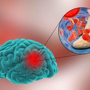 Tenecteplase on par with alteplase for acute ischaemic stroke