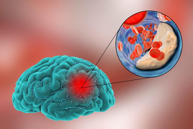 Tenecteplase on par with alteplase for acute ischaemic stroke